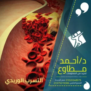 علاج التسرب الوريدى بالحقن